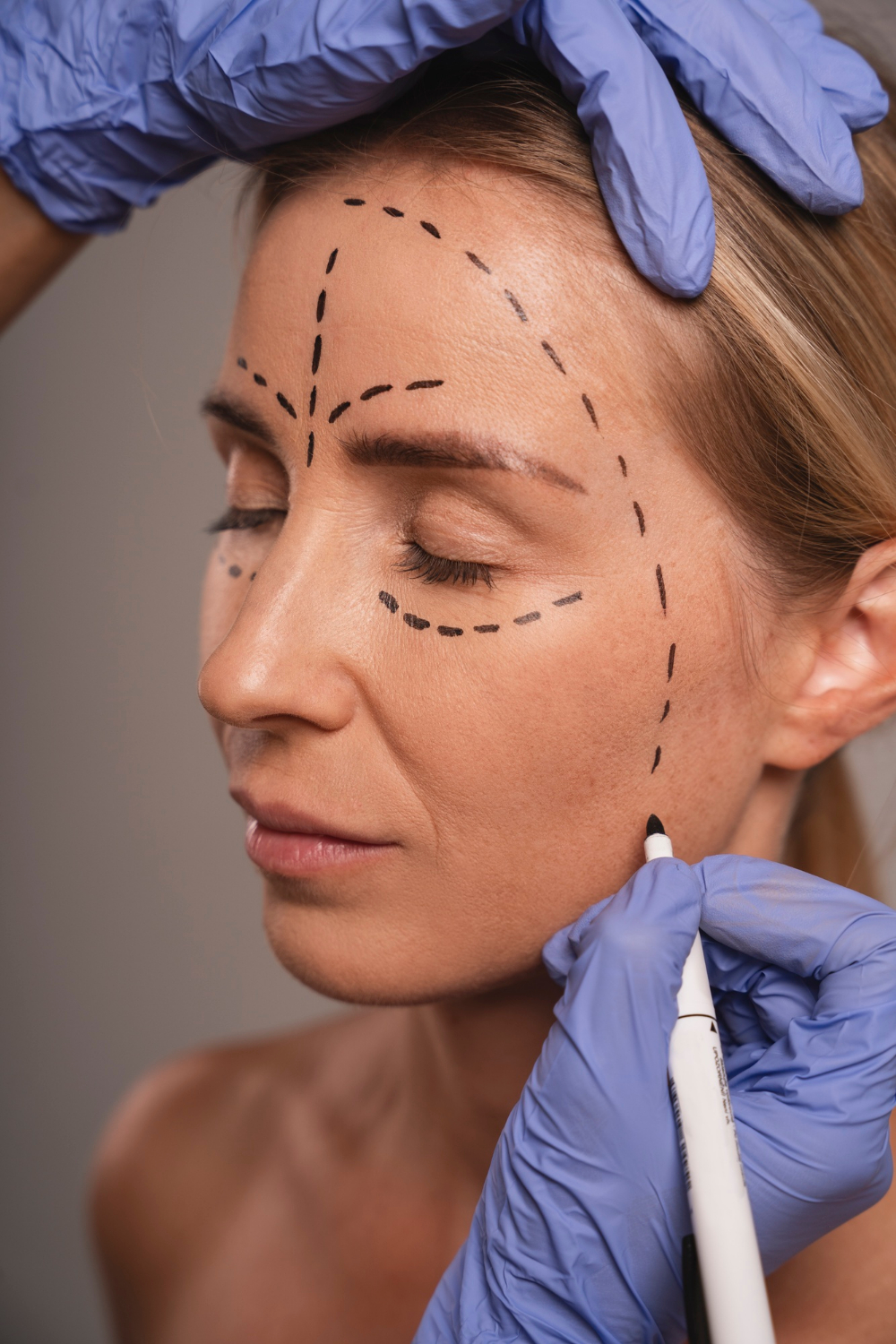 Harmonização Orofacial
